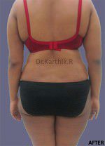 Liposuction Tummy and Back