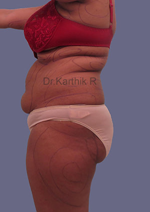 Liposuction Tummy and Back