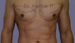 Gynecomastia (Puffy Nipples/ Male Chest Correction)