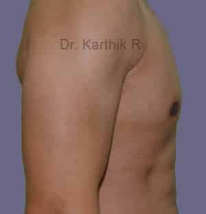 Gynecomastia (Puffy Nipples/ Male Chest Correction)