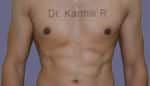 Gynecomastia (Puffy Nipples/ Male Chest Correction)