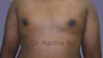 Gynecomastia (Puffy Nipples/ Male Chest Correction)