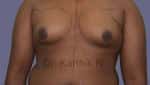 Gynecomastia (Puffy Nipples/ Male Chest Correction)