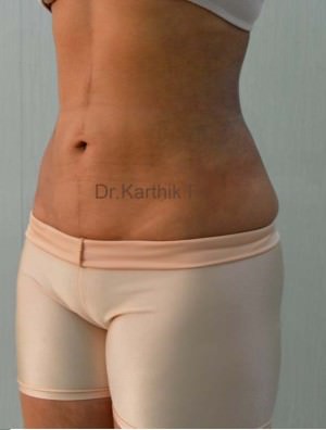 Liposuction Tummy and Back