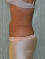 Liposuction Tummy and Back