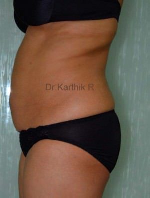 Liposuction Tummy and Back