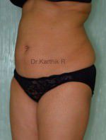 Liposuction Tummy and Back