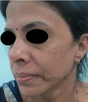 Non Surgical Face Lift