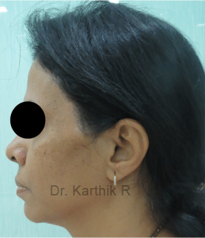 Non Surgical Face Lift