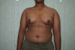 Gynecomastia (Puffy Nipples/ Male Chest Correction)