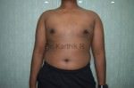 Gynecomastia (Puffy Nipples/ Male Chest Correction)