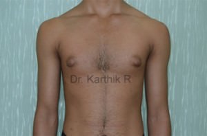 Gynecomastia (Puffy Nipples/ Male Chest Correction)