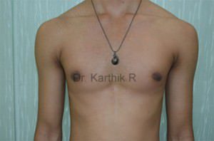 Gynecomastia (Puffy Nipples/ Male Chest Correction)