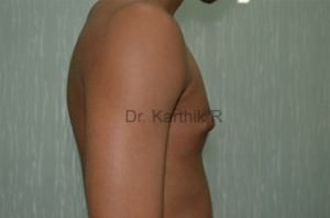Gynecomastia (Puffy Nipples/ Male Chest Correction)