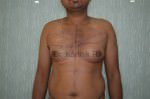 Gynecomastia (Puffy Nipples/ Male Chest Correction)
