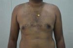 Gynecomastia (Puffy Nipples/ Male Chest Correction)