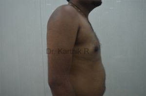Gynecomastia (Puffy Nipples/ Male Chest Correction)