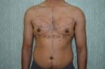 Gynecomastia (Puffy Nipples/ Male Chest Correction)