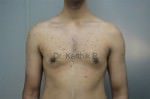 Gynecomastia (Puffy Nipples/ Male Chest Correction)