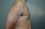 Gynecomastia (Puffy Nipples/ Male Chest Correction)