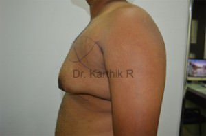 Gynecomastia (Puffy Nipples/ Male Chest Correction)