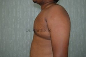 Gynecomastia (Puffy Nipples/ Male Chest Correction)