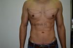 Gynecomastia (Puffy Nipples/ Male Chest Correction)