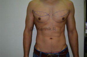 Gynecomastia (Puffy Nipples/ Male Chest Correction)