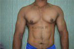 Gynecomastia (Puffy Nipples/ Male Chest Correction)