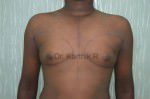 Gynecomastia (Puffy Nipples/ Male Chest Correction)