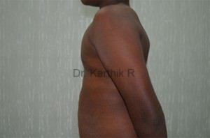 Gynecomastia (Puffy Nipples/ Male Chest Correction)