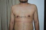 Gynecomastia (Puffy Nipples/ Male Chest Correction)