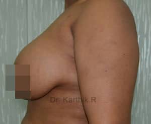 Breast Fat Fill (Breast Augmentation)