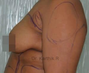 Breast Fat Fill (Breast Augmentation)