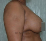 Breast Fat Fill (Breast Augmentation)