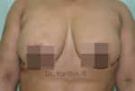 Breast Fat Fill (Breast Augmentation)