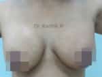 Breast Fat Fill (Breast Augmentation)