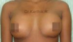Breast Implants (Breast Augmentation)