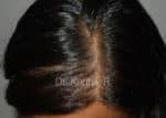 Female Hair Transplant