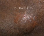 Scar Revision