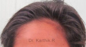 Female Hair Transplant