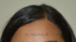 Female Hair Transplant