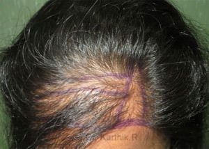 Female Hair Transplant