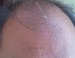 Hair Transplantation