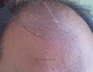 Hair Transplantation