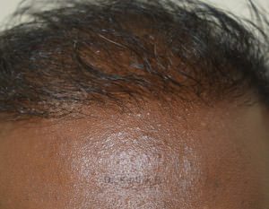 Hair Transplantation