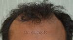 Hair Transplantation