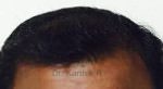 Hair Transplantation