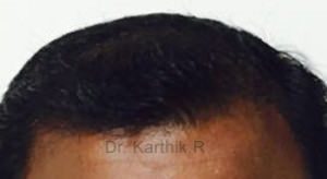 Hair Transplantation