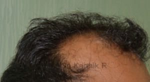Hair Transplantation